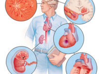 Злокачественная артериальная гипертензия: лечение и профилактика у гипертоников
